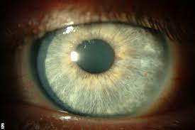 التهاب قرنية العين