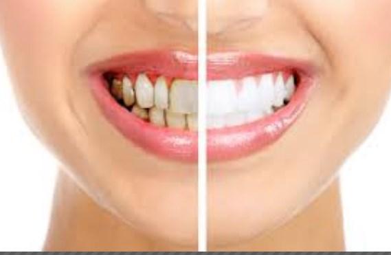 علاج جير الاسنان