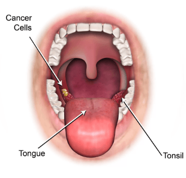 تشخيص سرطان الفم