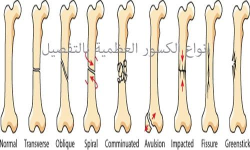 انواع الكسور العظمية بالتفصيل