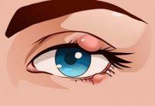 Upper Eyelid Inflammation