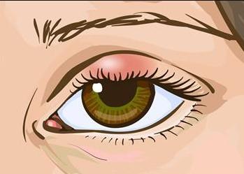 علاج التهاب جفن العين العلوي