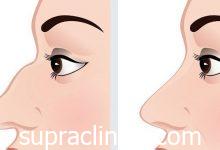 دليل عملية تجميل الأنف