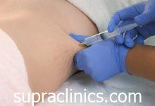 تكبير الثدي بحقن الدهون الذاتية