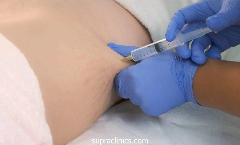 تكبير الثدي بحقن الدهون الذاتية