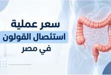 سعر عملية استئصال القولون في مصر بالمنظار والجراحة